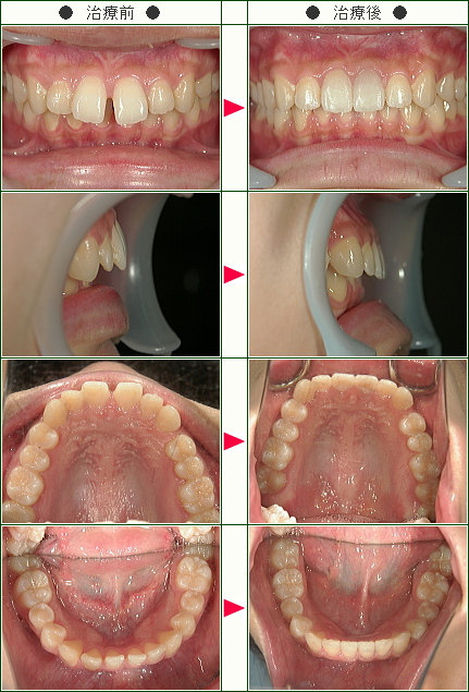 前歯のすきっ歯矯正症例(Ｏ.Ｙ様　２１歳　女性)