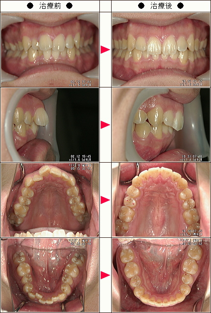 歯のデコボコ矯正症例［ＰＹＮ様　２２歳　男性］