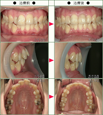 歯のデコボコ矯正症例(Ｒ様　２８歳　女性)