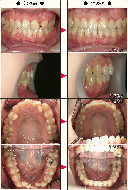 歯のデコボコ矯正症例［Ｒ様　女性］