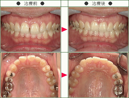前歯のすきっ歯矯正症例(Ｒ.Ａ様　２９歳　女性)