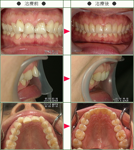 歯のデコボコ矯正症例(Ｒ・Ａ様　４５歳　女性)