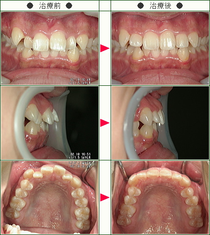 出っ歯矯正症例(玲様　１６歳　女性)