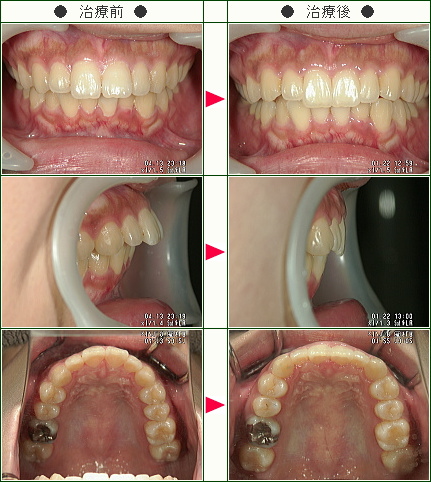 出っ歯矯正症例(Ｒ・Ｈ様　２２歳　女性)