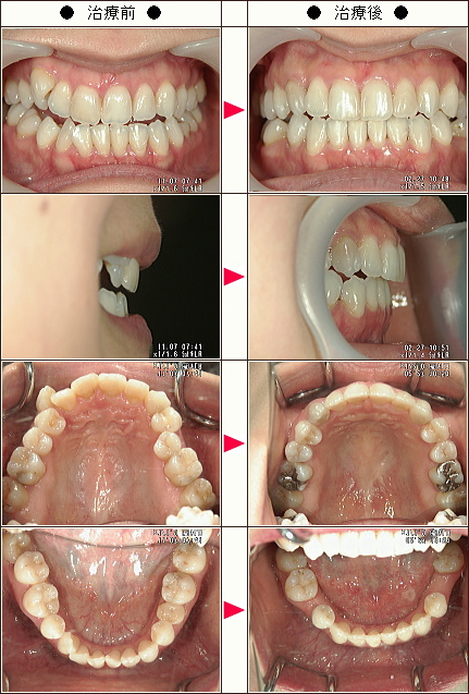 歯のデコボコ矯正症例［Ｒ.Ｉ様　３１歳　女性］