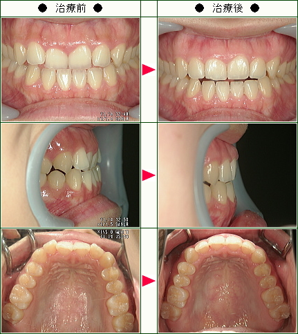 歯のデコボコ矯正症例(理子様　２４歳　女性)