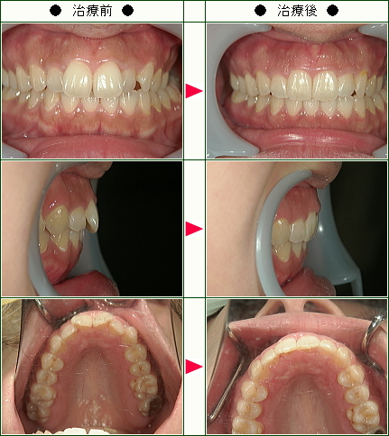 歯のデコボコ矯正症例(Ｒ.Ｋ様　２３歳　女性)