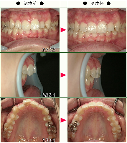 歯のデコボコ矯正症例(Ｒ.Ｋ様　２６歳　女性)