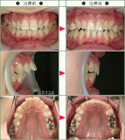 出っ歯矯正症例(Ｒ・Ｋ様　２６歳　女性)