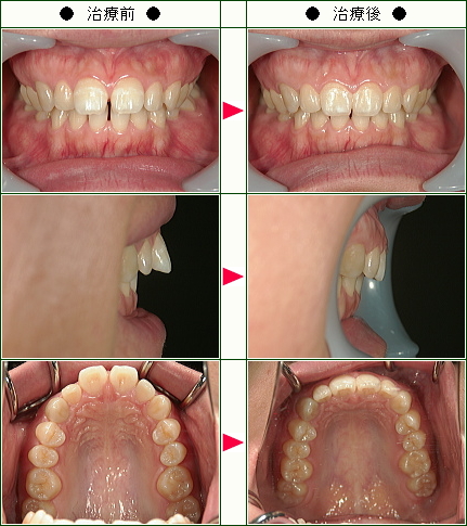 前歯のすきっ歯矯正症例(Ｒ.Ｋ様　２７歳　女性)