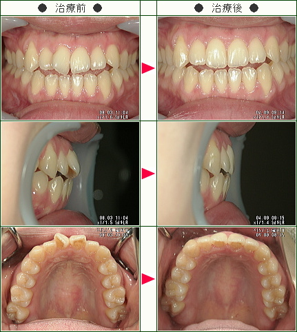 歯のデコボコ矯正症例(Ｒ・Ｍ様　２４歳　女性)