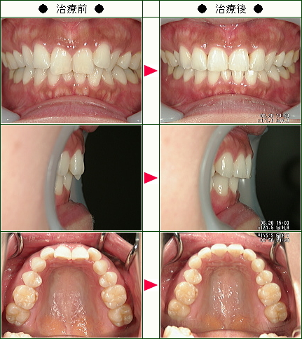 歯のデコボコ矯正症例(Ｒ．Ｍ様　３６歳　女性)