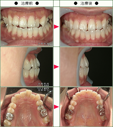 歯のデコボコ矯正症例(Ｒ.Ｎ様　３０歳　女性)