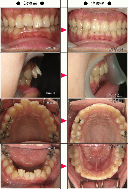 出っ歯矯正症例［Ｒ．Ｎ．様　３１歳　女性］