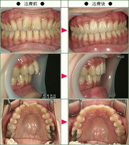 歯のデコボコ矯正症例(Ｒ.Ｎ様　３７歳　女性)