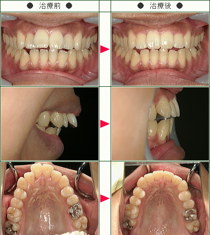出っ歯矯正症例(Ｒ・Ｎ様　３７歳　女性)