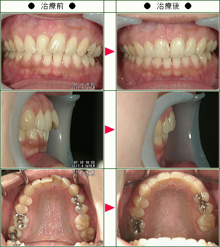歯のデコボコ矯正症例(Ｒ.Ｎ様　３８歳　女性)