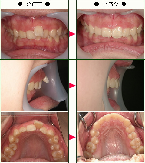 出っ歯矯正症例(Ｒ.Ｏ様　１８歳　女性)
