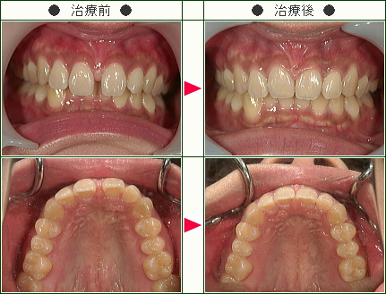 前歯のすきっ歯矯正症例(Ｒ．Ｏ様　２５歳　女性)