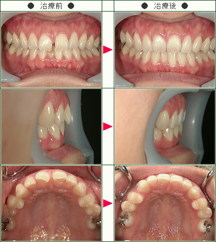 前歯のすきっ歯矯正症例(ロースカツ丼様　３０歳　女性)