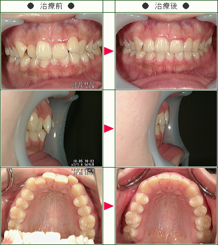 歯のデコボコ症例(Ｒ.Ｓ様　１９歳　女性)