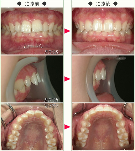 出っ歯矯正症例(Ｒ・Ｔ様　２０歳　女性)