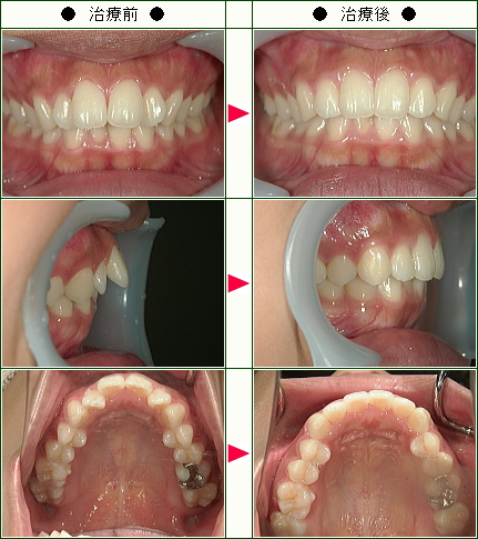 歯のデコボコ矯正症例(Ｒ．Ｔ様　２４歳　女性)