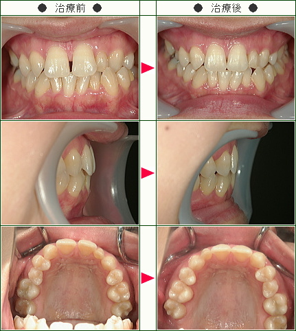 前歯のすきっ歯矯正症例(Ｒ.Ｔ様　３４歳　女性)