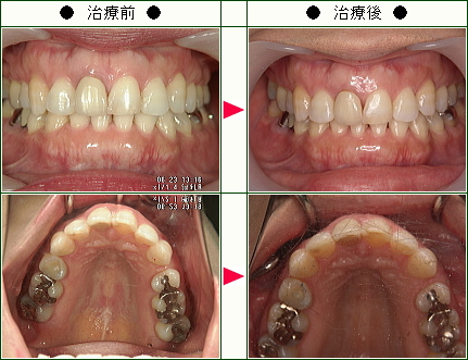 歯のデコボコ矯正症例(Ｒ.Ｔ様　４０歳　女性)