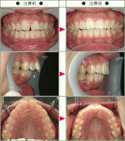 前歯のすきっ歯矯正症例(るな様　１５歳　女性)