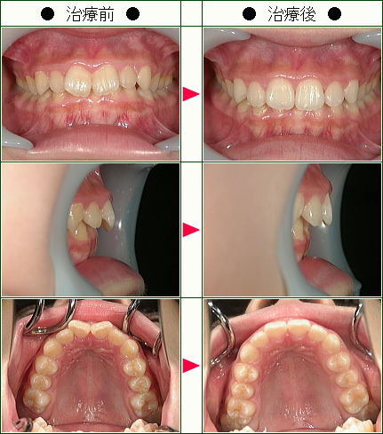 歯のデコボコ矯正症例(Ｒ．Ｙ様　１３歳　女性)