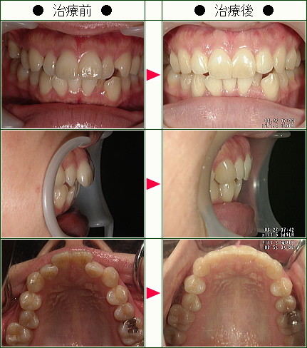 歯のデコボコ矯正症例(Ｒ・Ｙ様　２６歳　女性)