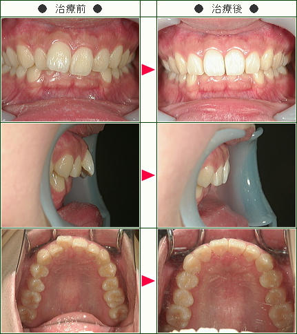 出っ歯矯正症例(Ｓ様　１６歳　女性)
