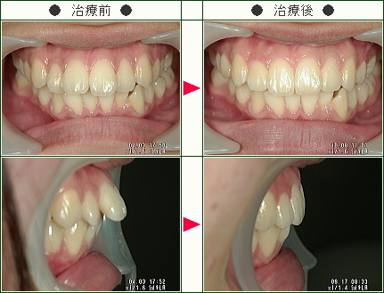 出っ歯矯正症例(Ｓ様　１７歳　女性)