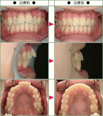 出っ歯矯正症例(Ｓ様　２２歳　女性)