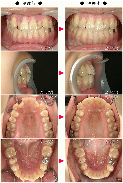 歯のデコボコ矯正症例(Ｓ様　２５歳　女性)