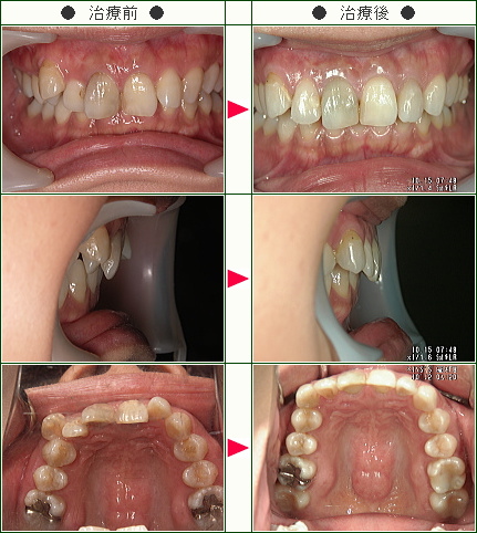 歯のデコボコ矯正症例(Ｓ様　３１歳　女性)