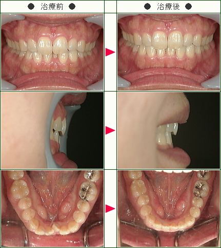 矯正 歯並び
