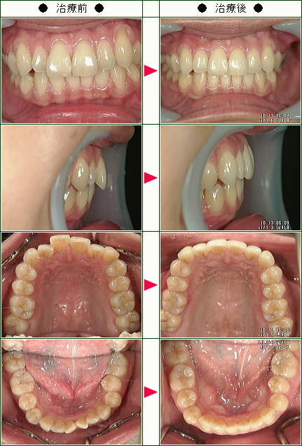歯のデコボコ矯正症例(Ｓ様　３７歳　女性)