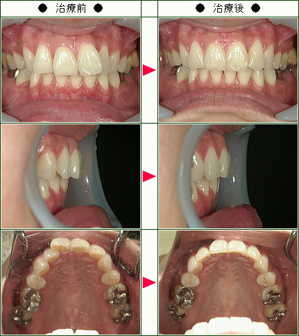 歯のデコボコ矯正症例(Ｓ様　３７歳　女性)