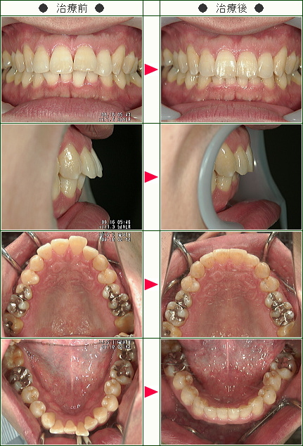 出っ歯矯正症例(Ｓ様　４２歳　男性)