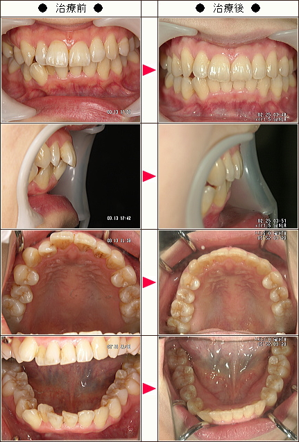 出っ歯矯正症例［Ｓ・Ａ様　３１歳　女性］