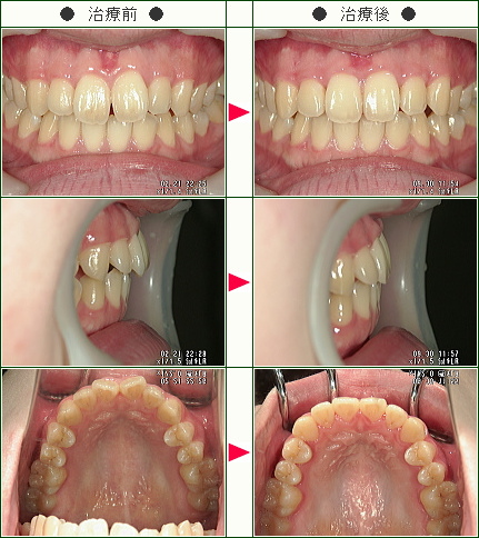 歯のデコボコ矯正症例(三郎様　１９歳　女性)
