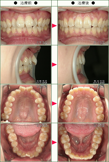 歯のデコボコ矯正症例(さちも様　３０歳　女性)