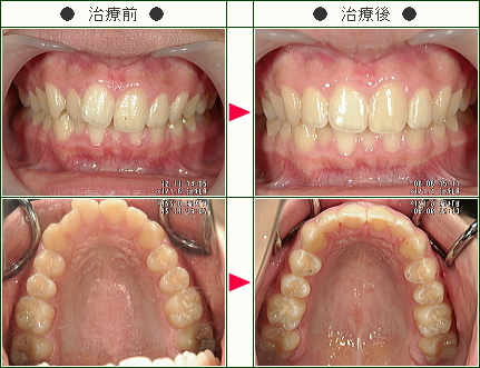 歯のデコボコ矯正症例(佐川様　１６歳　女性)