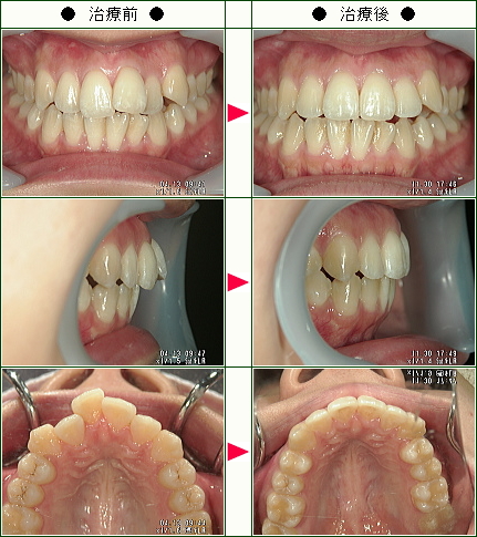 歯のデコボコ矯正症例(坂本様　２５歳　女性)