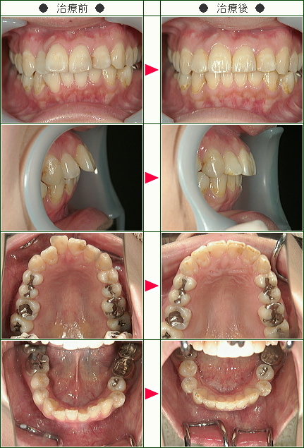 出っ歯矯正症例(坂本様　３０歳　女性)