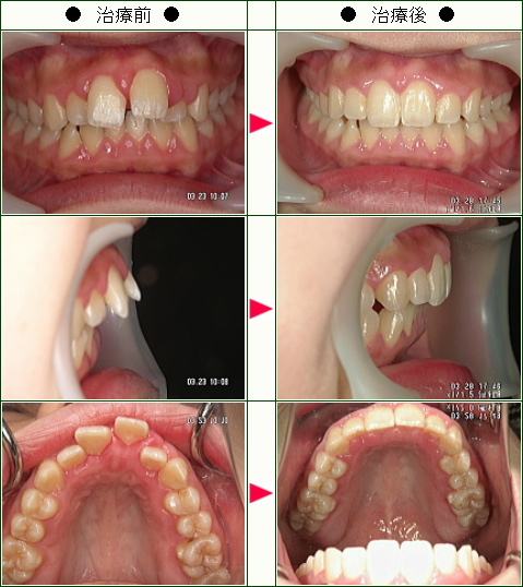 出っ歯矯正症例(さき様　１６歳　女性)