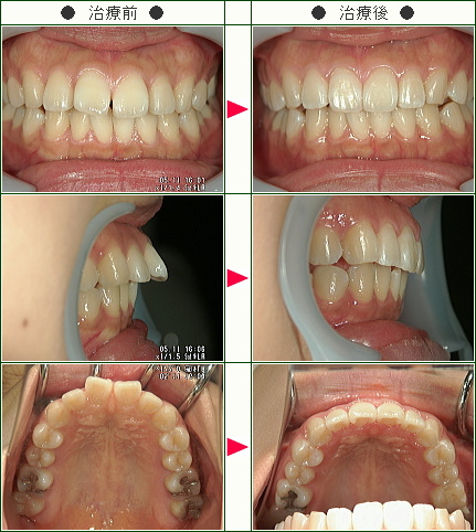 出っ歯矯正症例(櫻井様　２３歳　女性)
