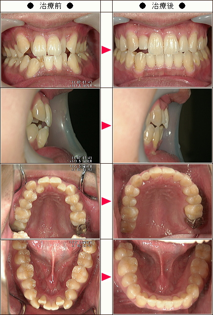 歯のデコボコ矯正症例［咲夜様　３０歳　男性］